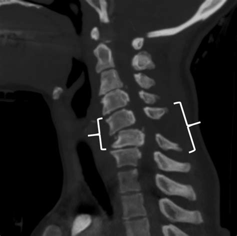 Parsing The Utility Of Ct And Mri In The Subaxial Cervical Spine Injury