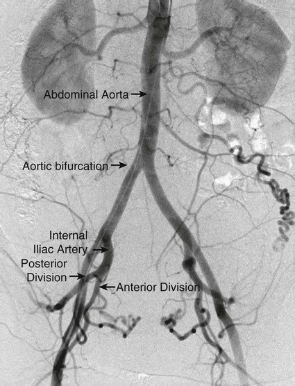 Pelvic Arterial Anatomy Angiogram Human Anatomy