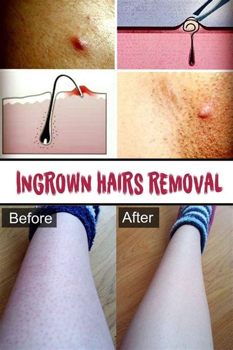 Ingrown Hairs Removal IngrownHairOnVagina HairRemovalUnderarm In 2020