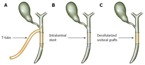 Repair Of A Common Bile Duct Defect With A Decellularized Ureteral Graft