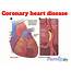 Coronary Heart Disease  Malaysia Health Family Medicine And Healthcare