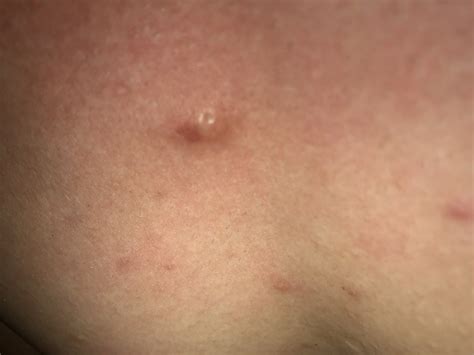 What Is This On My Chest Cyst Backbodyneck Acne By Plcode