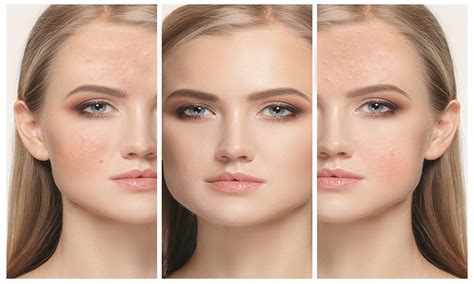 Skin Clinic How Skin Peels Can Help Treat Acne And The Signs Of Ageing