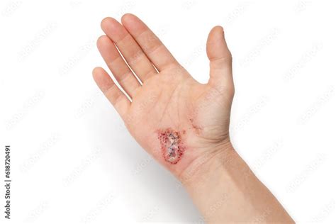Hand With Stiches Or Laceration After Fall Female Hand With Sutured
