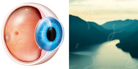 Eye Floaters Causes And Symptoms Self