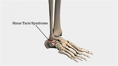 Outside Ankle Pain Outer Ankle Pain