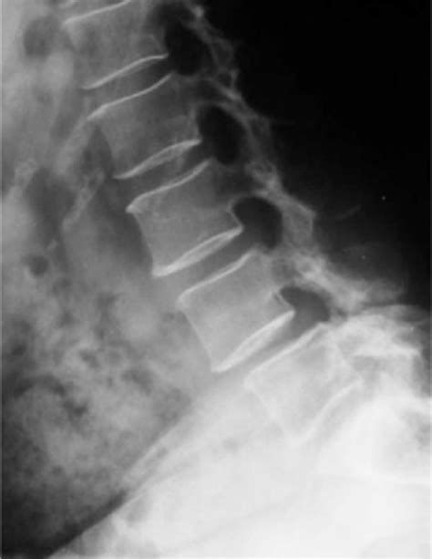 Synovial Facet Cyst Spine Orthobullets