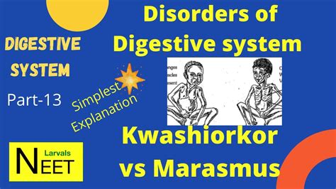 Kwashiorkor And Marasmus In Hindi Protein Energy Malnutrition Class
