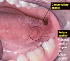 Mom Tongue Tonsil Tounge Tonsil Symptoms Swolen | Duoalbarus Tonsilremoval