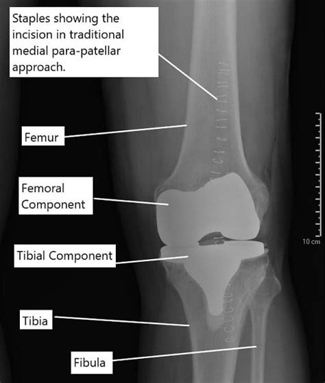 Minimally Invasive Vs Total Knee Replacement Complete Orthopedics