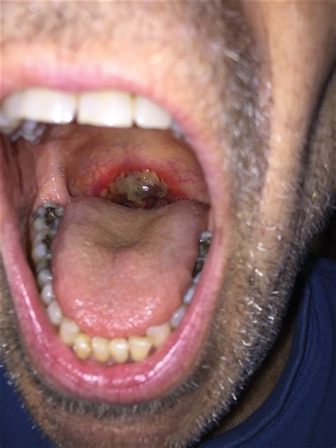 Friable Erythema And Erosions On The Mouth Mdedge Dermatology