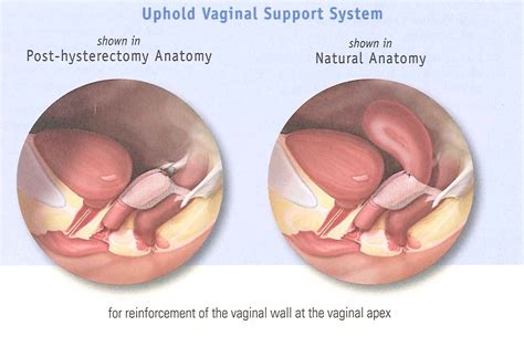 Vaginal Vault Prolapse