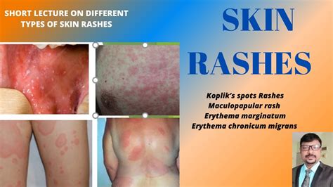 Skin Rashes Different Types Of Skin Rashes In High Fever Kopliks