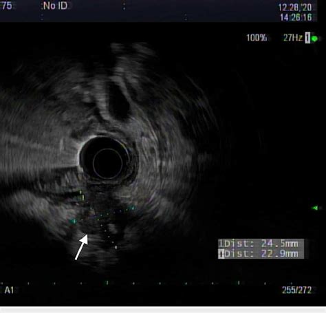 Esophageal Carcinoma Seen On Endoscopic Ultrasound Eus Evaluation