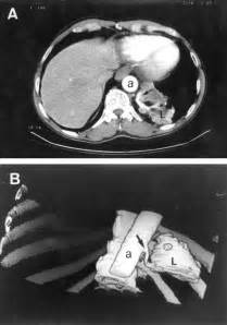 Diagnosis Of Pulmonary Sequestration By Spiral Ct Angiography Thorax