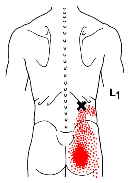 Iliocostalis Lumborum The Trigger Point And Referred Pain Guide