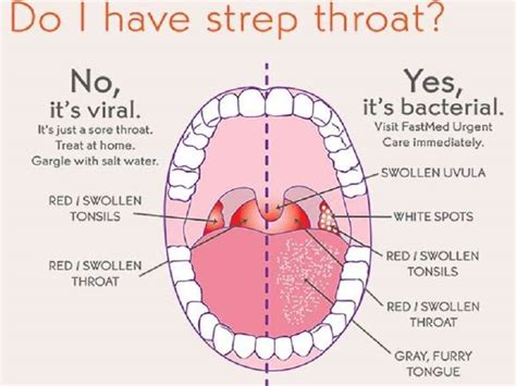 Strep Throat Treatment At Our Primary Care Clinic In Jacksonville