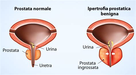 Prostata Ingrossata Cause Sintomi Rimedi Naturali E Farmaci