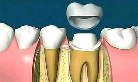 为什么牙齿做根管治疗后要戴牙冠？ 健康160