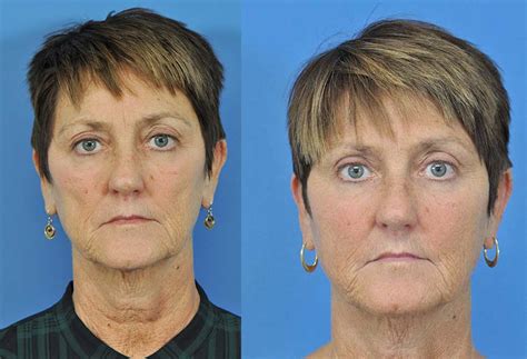 Sculptra Before And After Savannah Facial Plastic Surgery