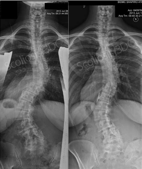 Adult Reduces Scoliosis Adult Scoliosis Improving Scoliosis In Adults