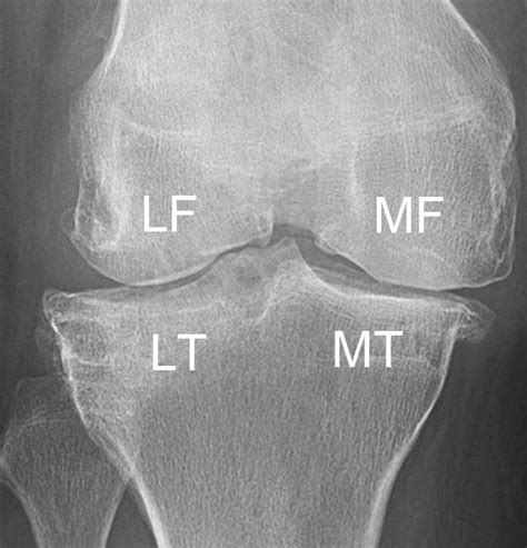 Detection Of Osteophytes And Subchondral Cysts In The Knee With Use Of Tomosynthesis Radiology