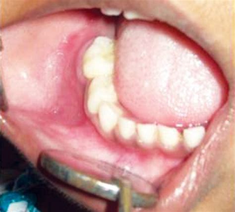 Intraoral Clinical Photograph Showing Minimal Right Side Buccal Sulcus
