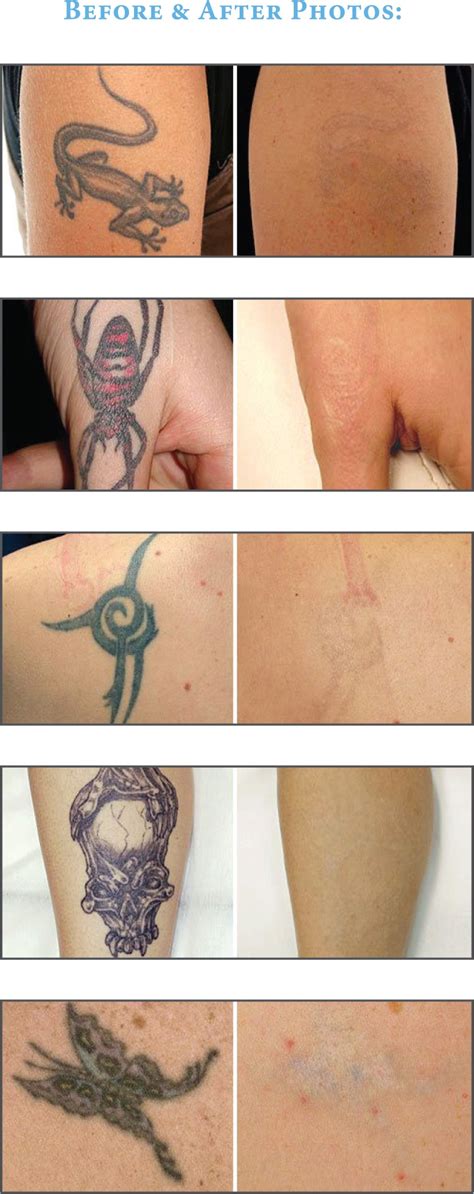 Today, there is an increasing demand for the removal of tattoos. ClearSteps Laser Tattoo Removal - Los Angeles California ...
