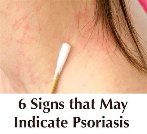 6 Signs That May Indicate Psoriasis Symptoms Psoriasis Symptoms