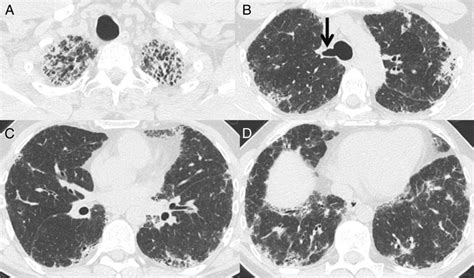 Ct Scan Findings Of Probable Usual Interstitial Pneumonitis Have A High