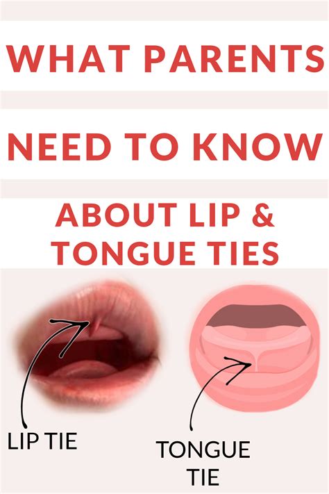 What Parents Want To Know About Tongue Ties And Lip Ties — In Home