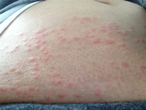 Itchy Rash On Stomach Belly Button Rash Treatment Causes Pictures
