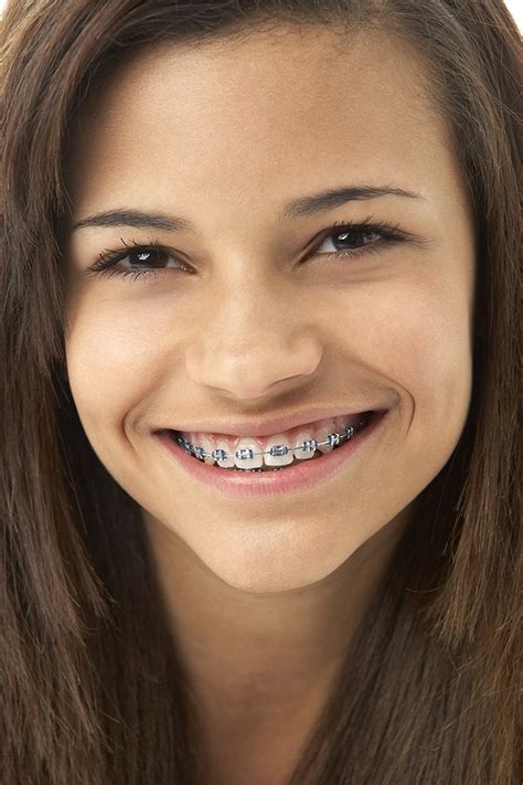 Can Braces Widen Your Smile North Shore Orthodontics