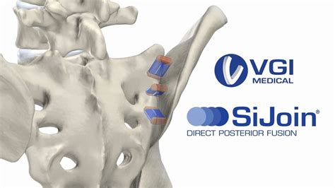 VGI Medical Presents SiJoin Direct Posterior Sacroiliac SI Joint Fusion YouTube