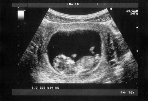 Add your sonogram pictures also so we can see all these new babies. When You Can See A Baby on The Ultrasound Scan