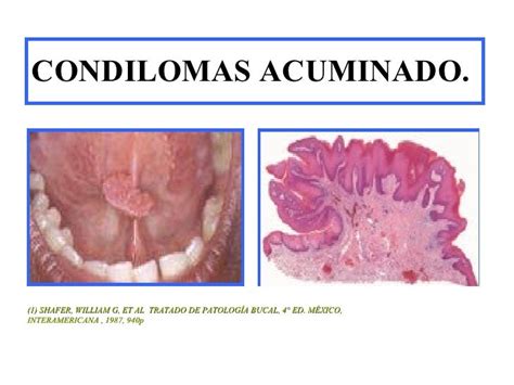 Patologia Oral Infección Papiloma Humano