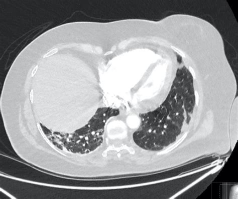 Axial Lung Window Images From Ct Pulmonary Angiogram Demonstrates