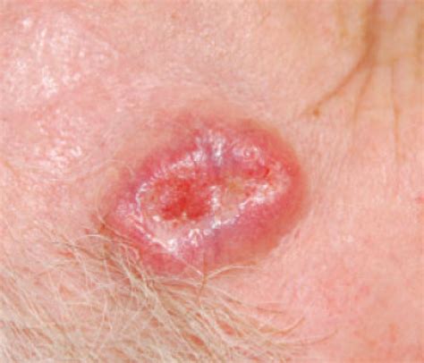 Skin Cancer Sores