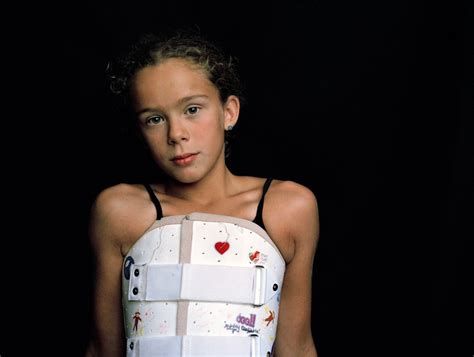 Powerful Photos Show Teen Girl Overcoming Idiopathic Scoliosis After Having To Wear Back Brace