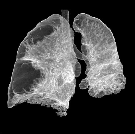 Emphysema Of The Lungs Ct Scan Photograph By Du Cane Medical Imaging