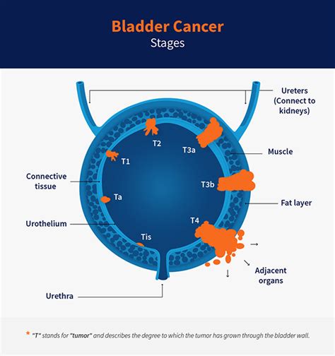 Bladder Cancer Stages Cxbladder