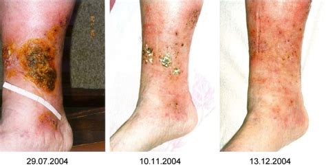 Example Of A Healing Process Of A Chronic Venous Stasis Ulcer Of The