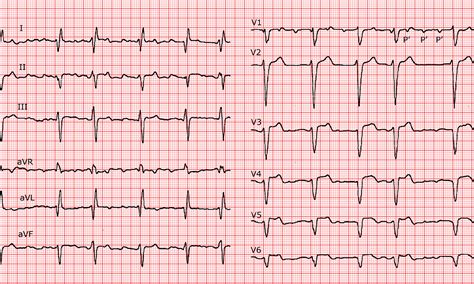 Cardio Fr Atypical Atrial Flutter Type Ii With Variable Conduction