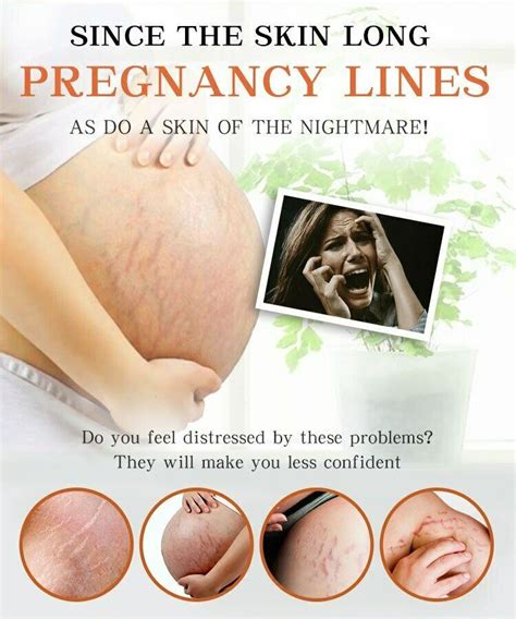 Maternity Scars Acne Cream Pregnancy Stretch Marks Remove Cream 7 Day Effect Venicare