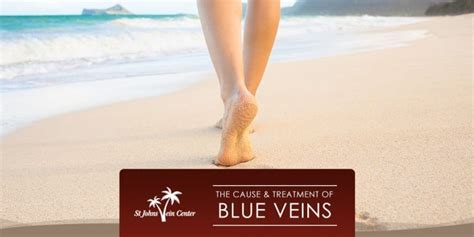 The Cause And Treatment Of Blue Veins In Jacksonville