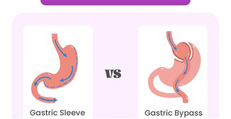 Gastric Sleeve Surgery Vs Gastric Bypass Which Is Right For You