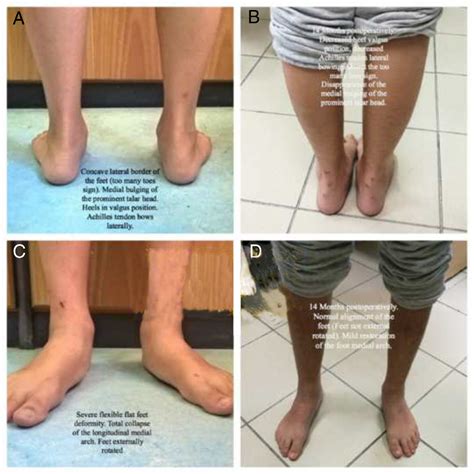 Arthroereisis For Symptomatic Flexible Flatfoot Deformity In Young
