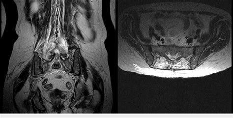 Sagittal And Axial T1 Weighted Mri Obtained Upon Discharge Showing No