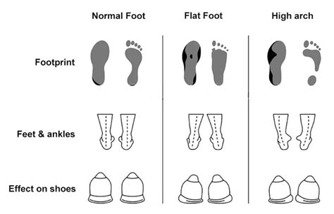 Supination Foot Biomechanics Explained Types Causes And Treatment