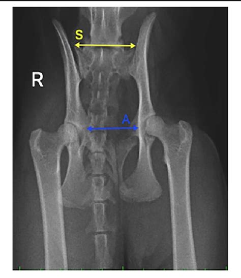Figure 2 From Conservative Management Of Sacroiliac Luxation Fracture